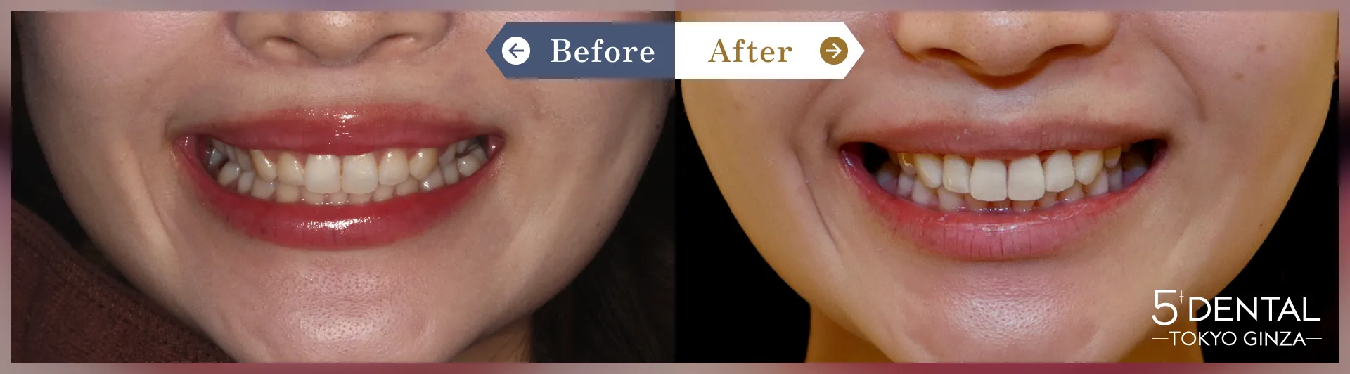 ガミースマイル治療 Before/After症例15