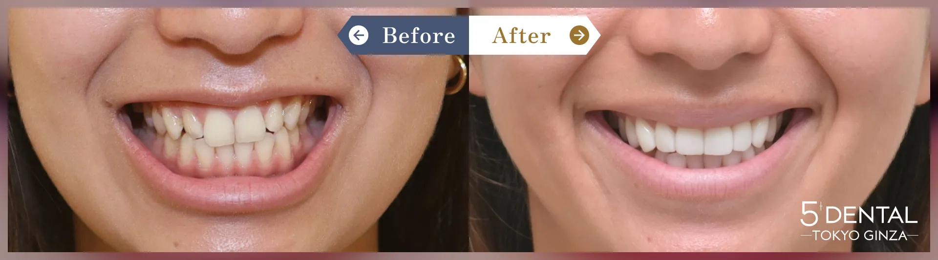 ガミースマイル治療 Before/After症例2