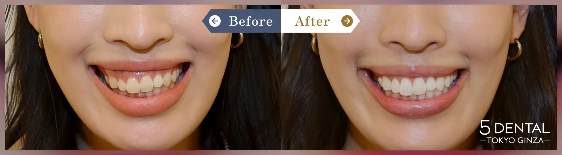 ガミースマイル治療 Before/After症例3