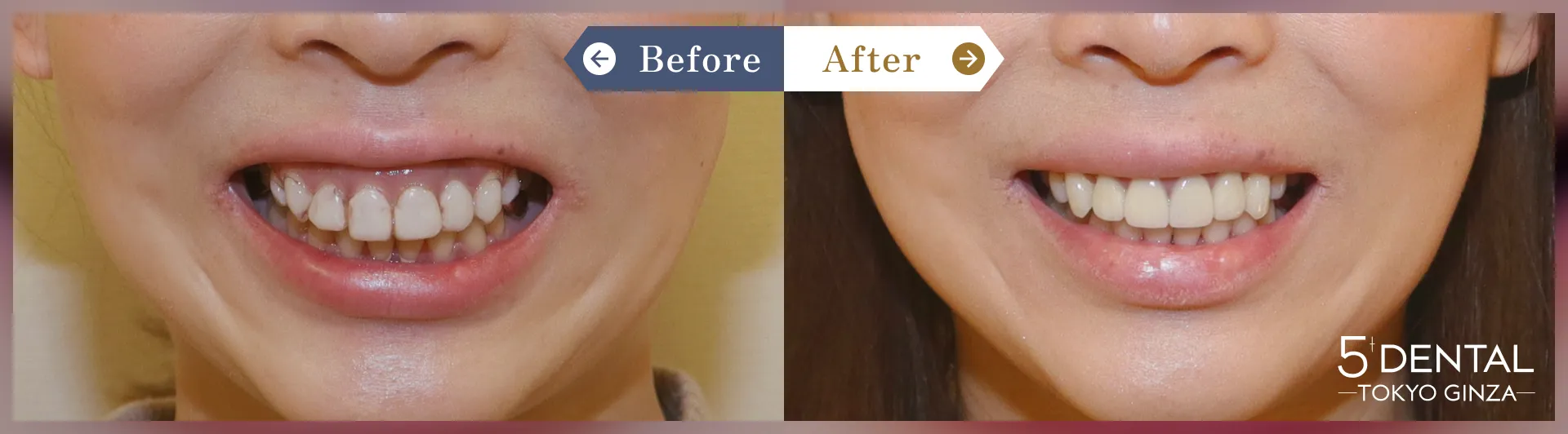 ガミースマイル治療 Before/After症例5