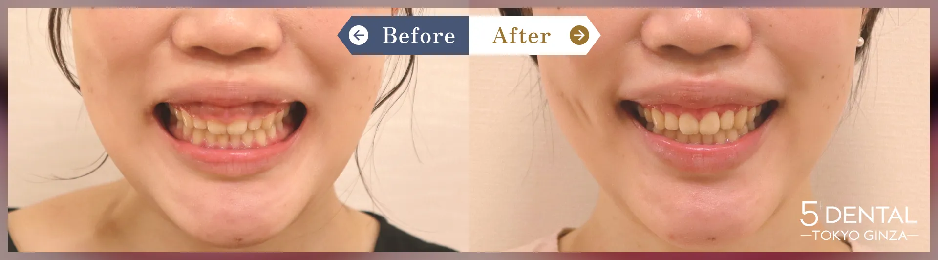 ガミースマイル治療 Before/After症例7