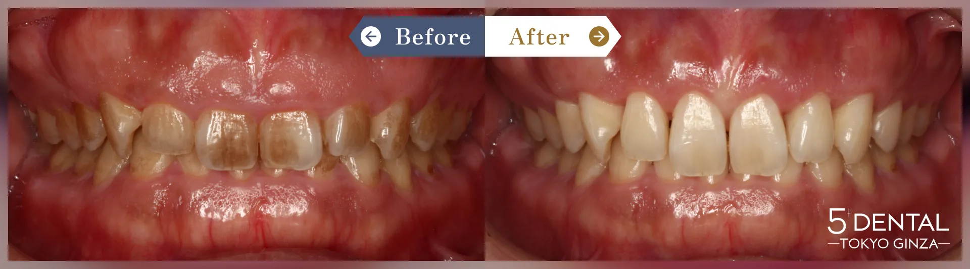 ガミースマイル治療 Before/After症例8