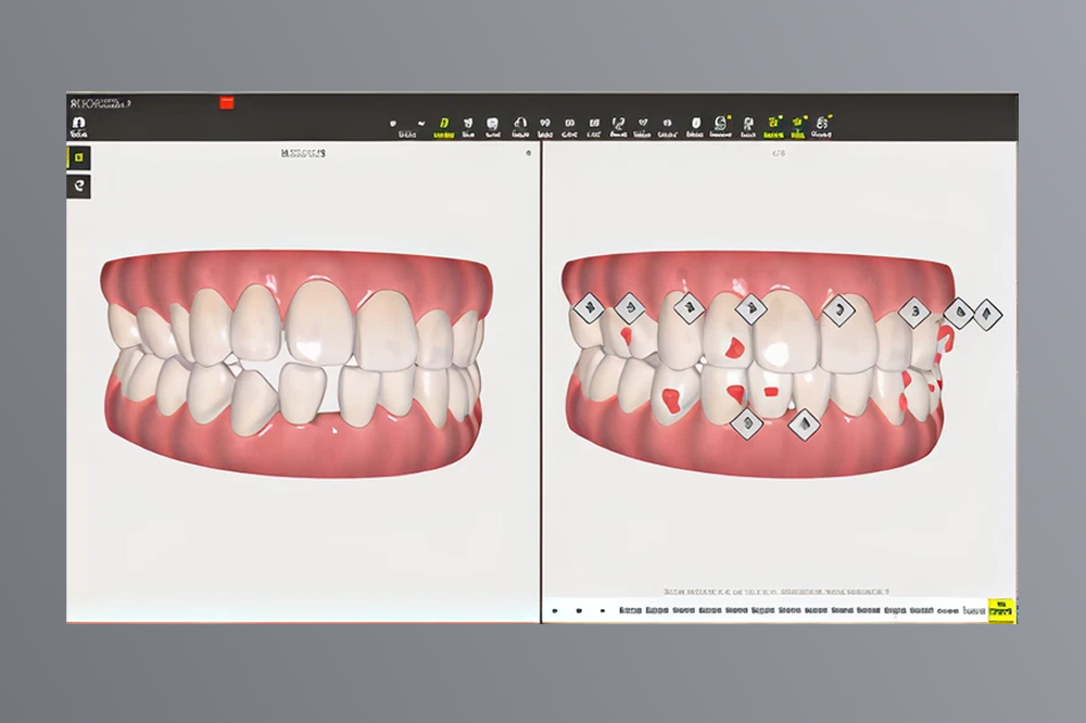インビザラインGOマウスピース