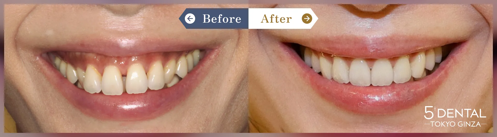 インビザラインGO Before/After症例