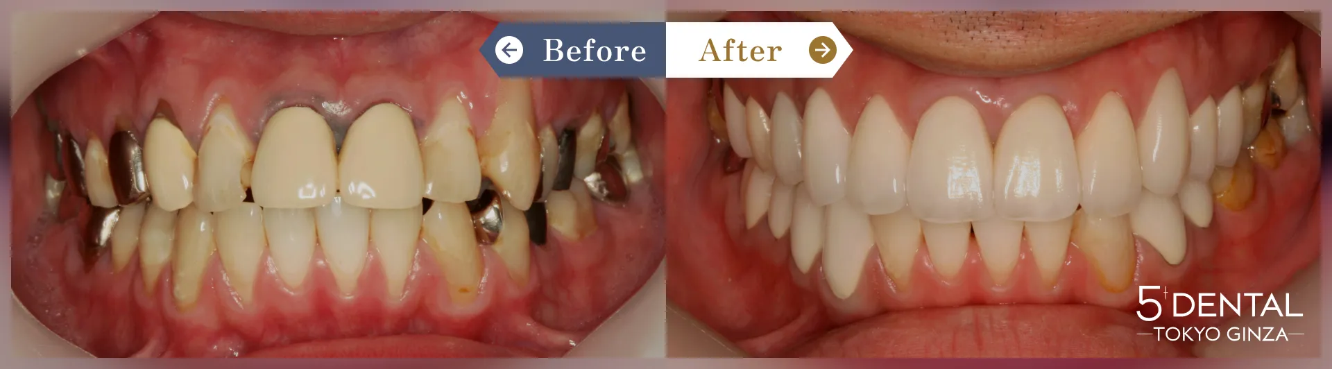 差し歯の色 Before/After症例2
