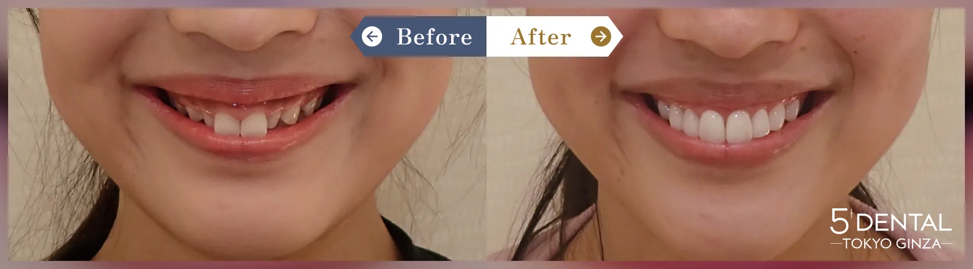 Case2 上前歯8本 ラミネートベニア + 歯肉整形