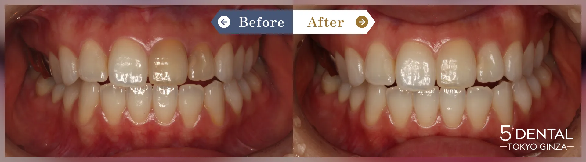 失活歯・変色歯 Before/After症例10