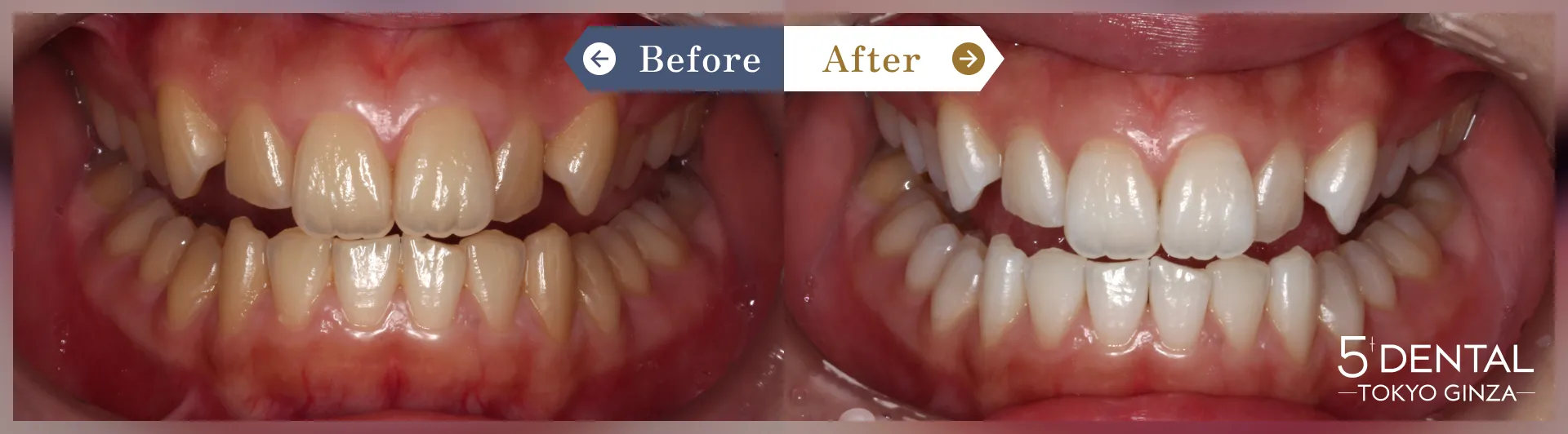 失活歯・変色歯 Before/After症例13