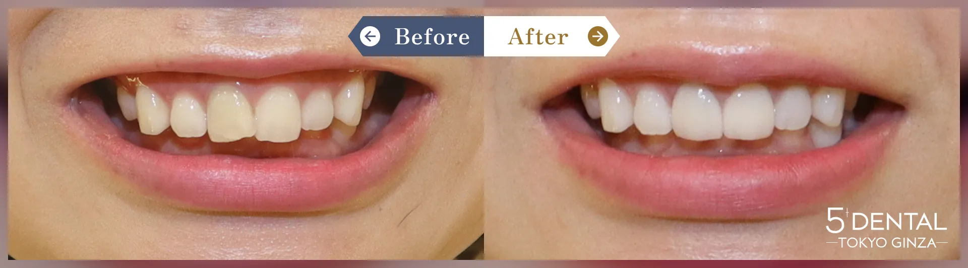 失活歯・変色歯 Before/After症例4