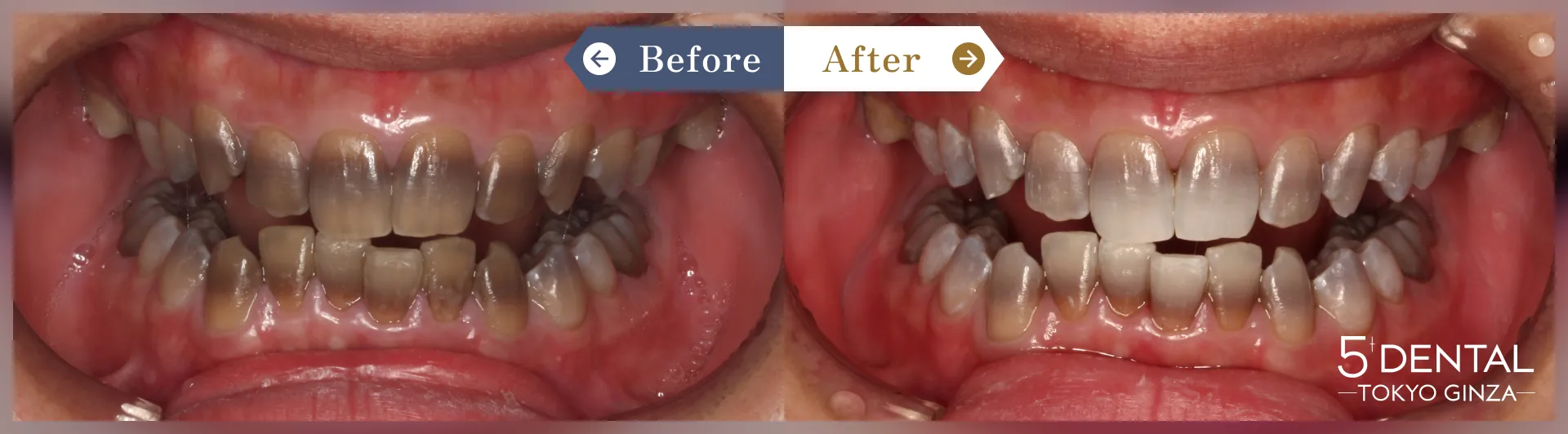 失活歯・変色歯 Before/After症例5