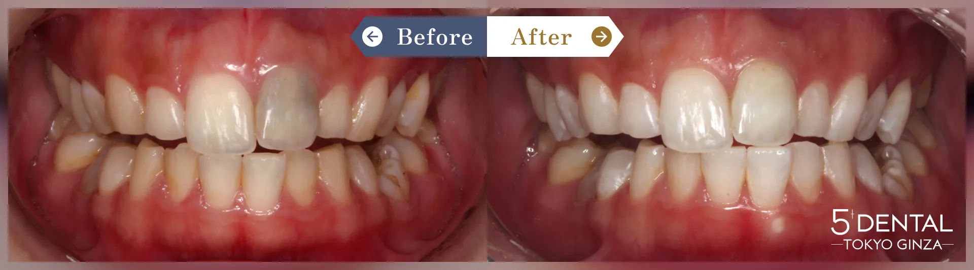 失活歯・変色歯 Before/After症例9