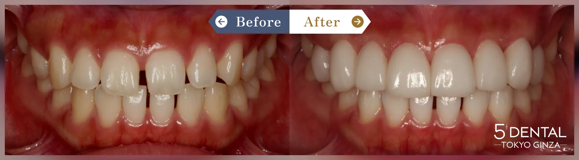 すきっ歯・矮小歯 Before/After症例5