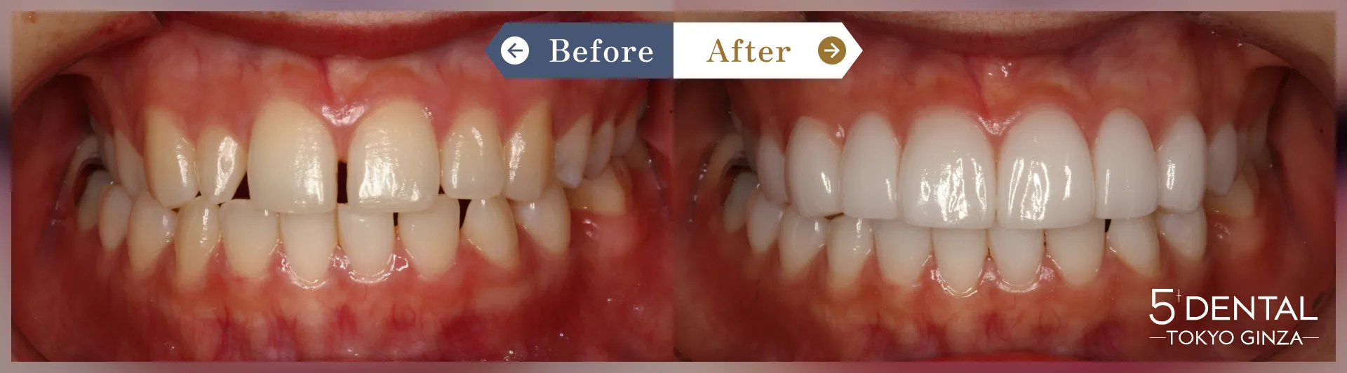 すきっ歯・矮小歯 Before/After症例6
