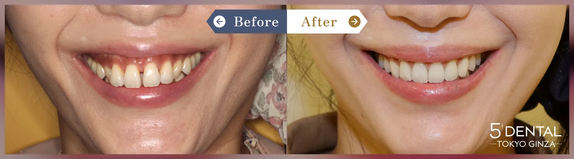 すきっ歯・矮小歯 Before/After症例9