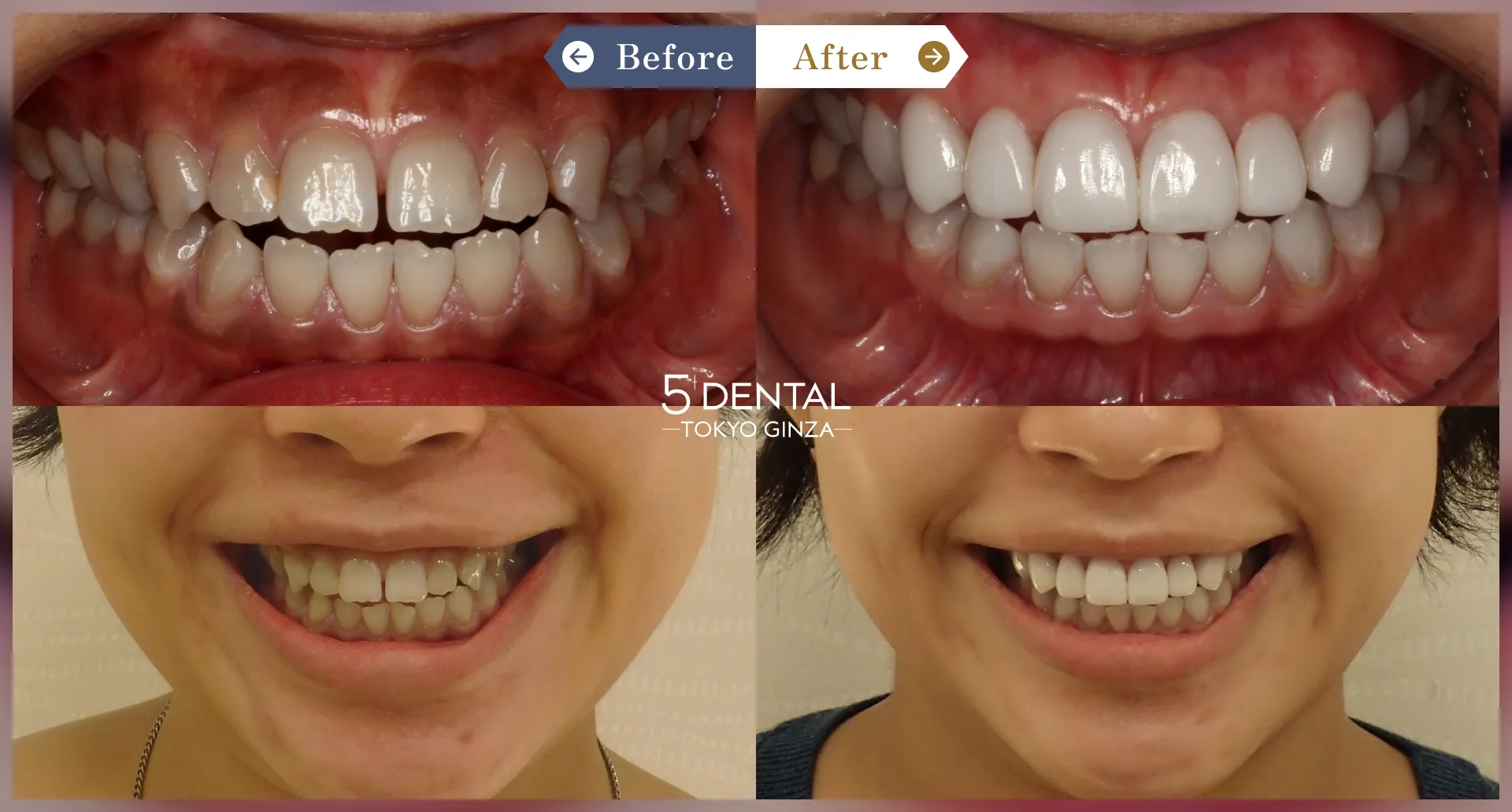 テトラサイクリン歯 Before/After症例1