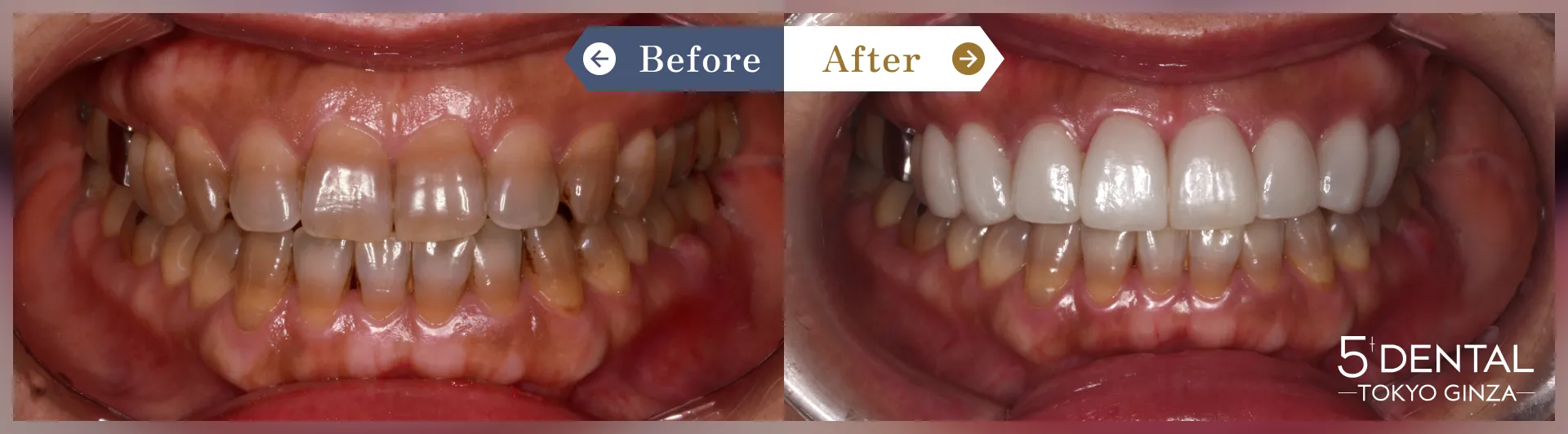 テトラサイクリン歯 Before/After症例2