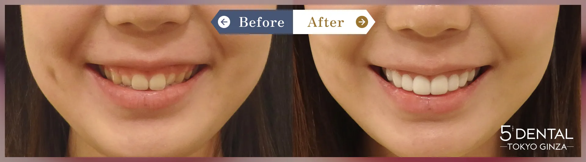 歯を大きくしたい Before/After症例1