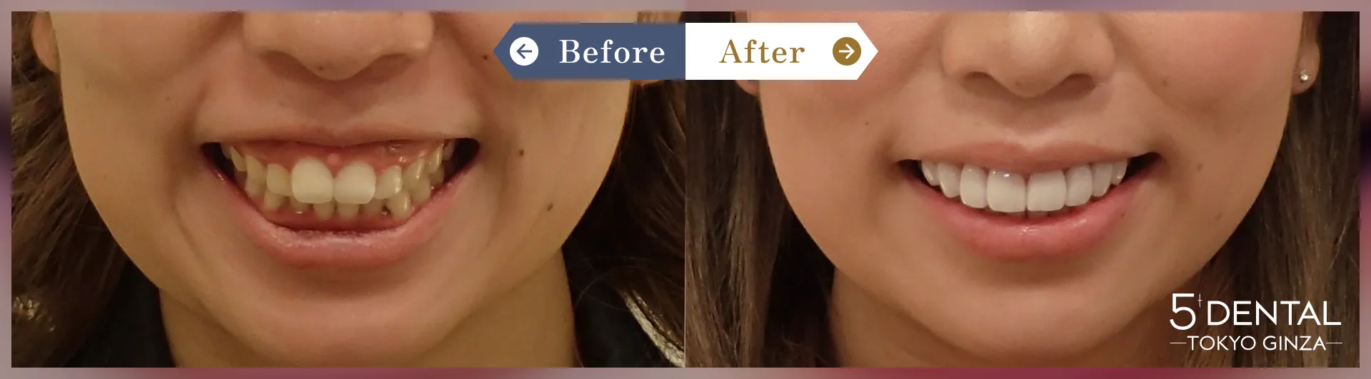 歯を大きくしたい Before/After症例2