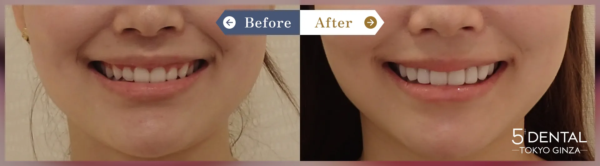 歯を大きくしたい Before/After症例5