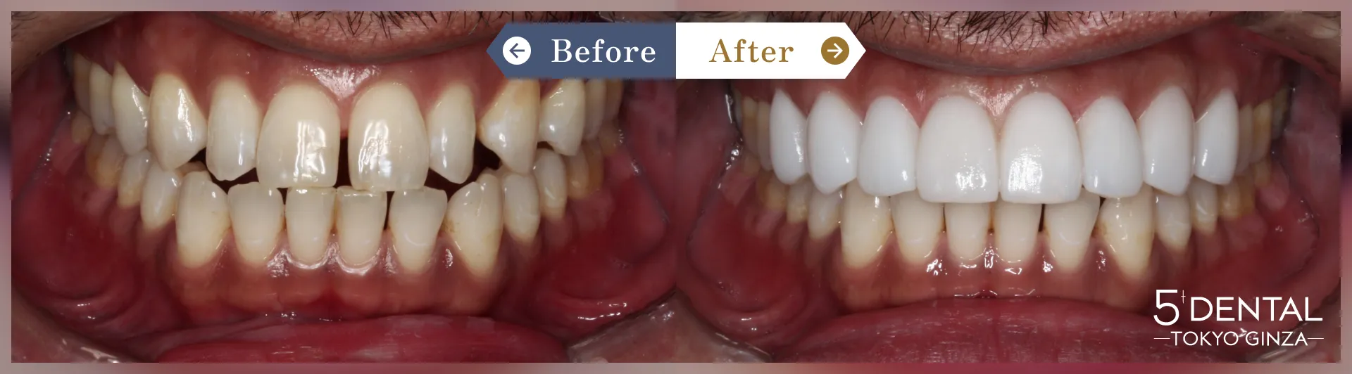 歯を真っ白にしたい Before/After症例1
