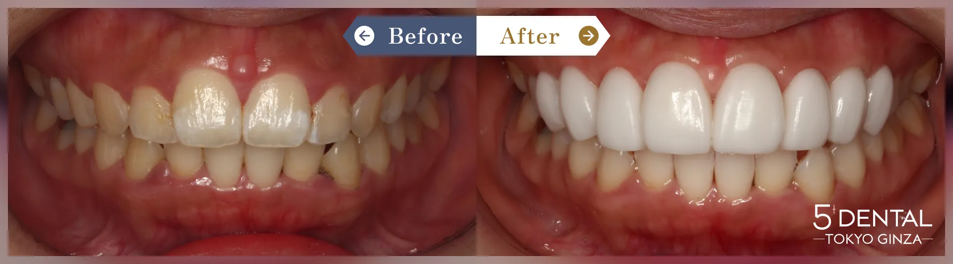 歯を真っ白にしたい Before/After症例2