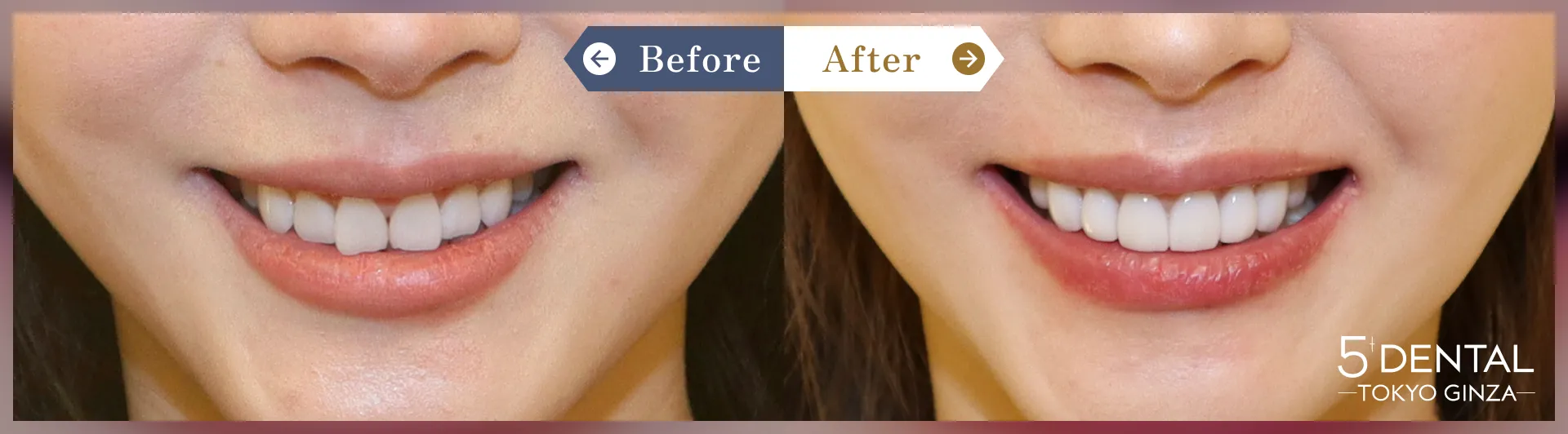 歯を真っ白にしたい Before/After症例3