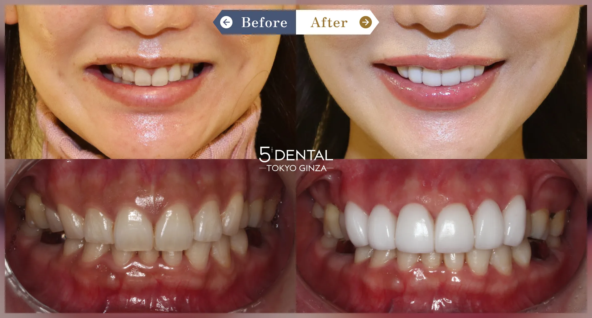 歯を真っ白にしたい Before/After症例4