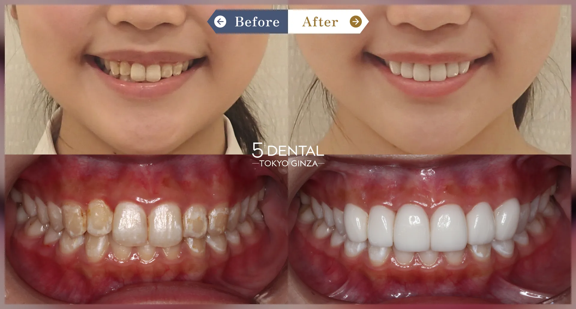 歯を真っ白にしたい Before/After症例5