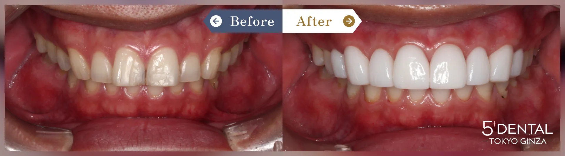 歯を真っ白にしたい Before/After症例6