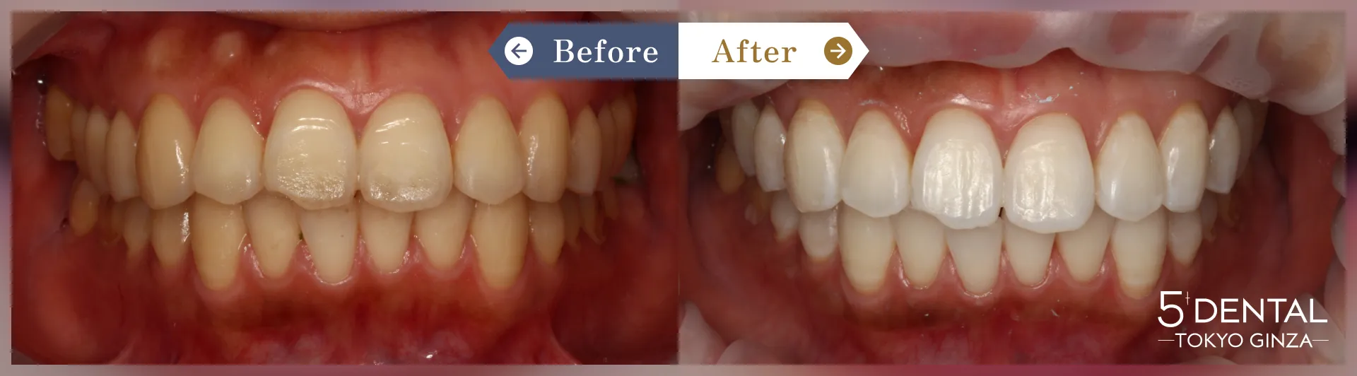 ホワイトニング Before/After症例2