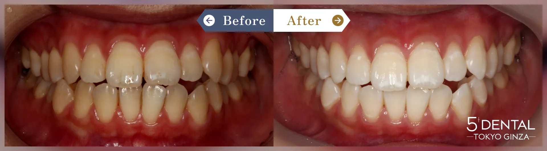 ホワイトニング Before/After症例3