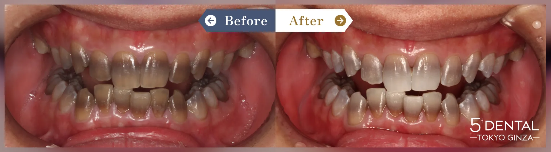 ホワイトニング Before/After症例6
