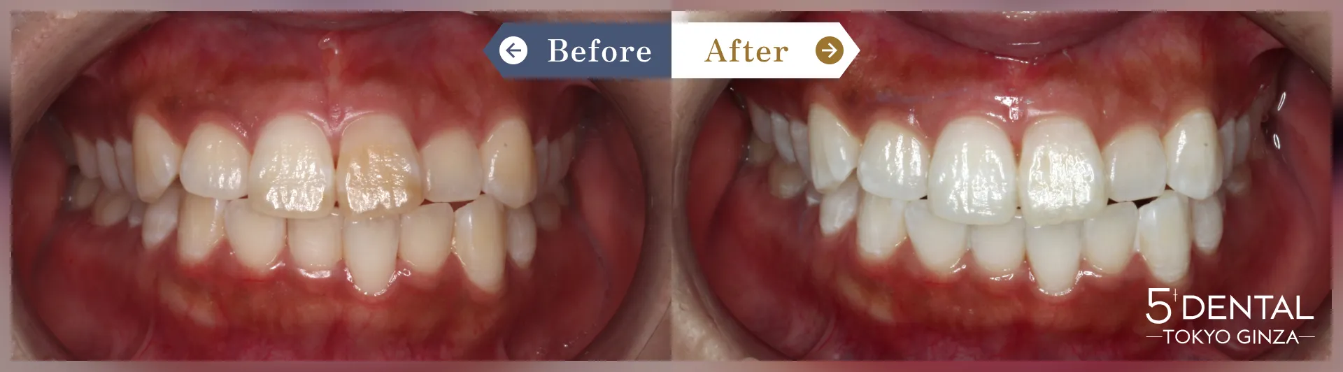 ホワイトニング Before/After症例7-2