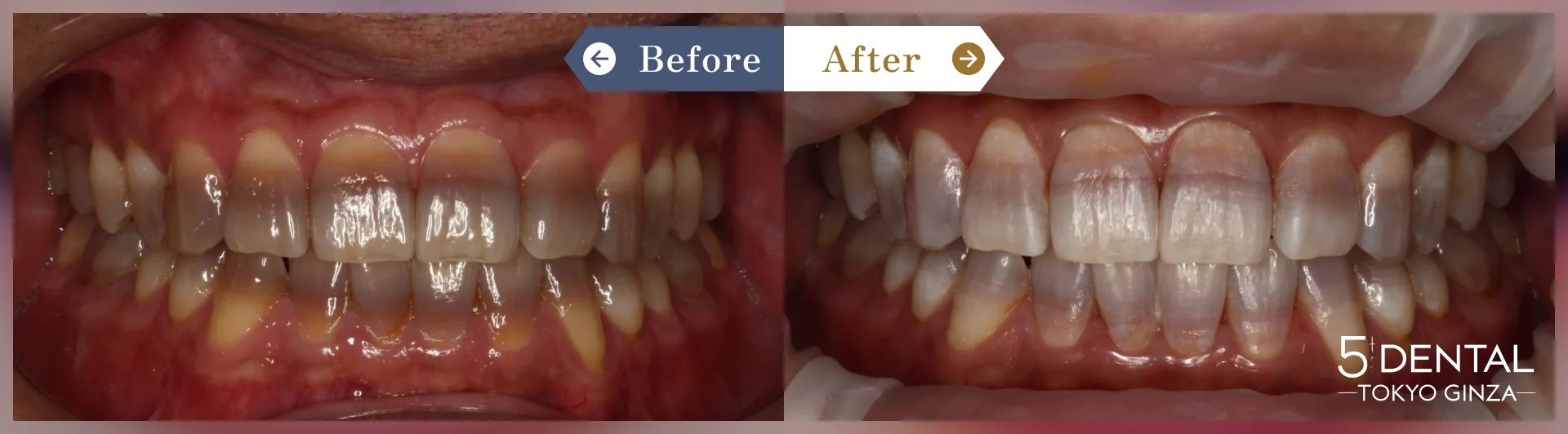 ホワイトニング Before/After症例7
