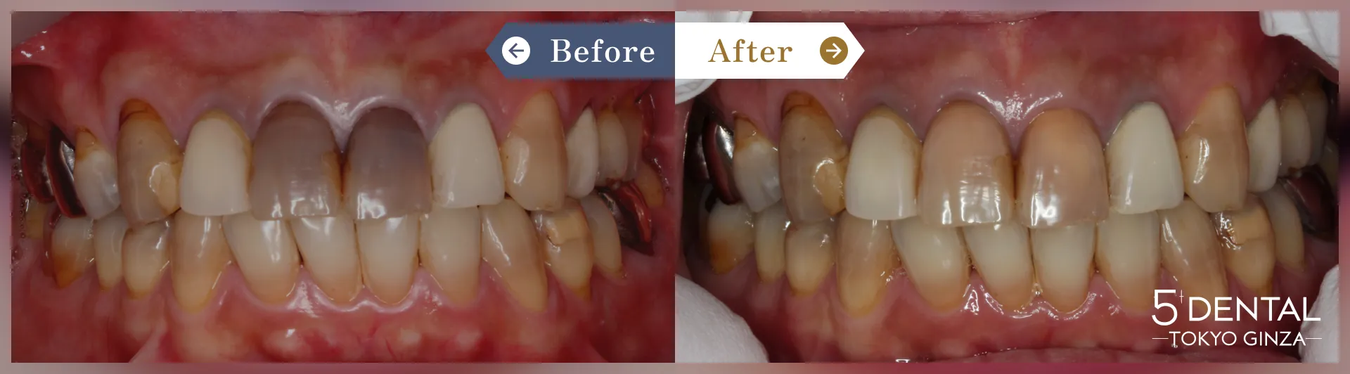 ホワイトニング Before/After症例8
