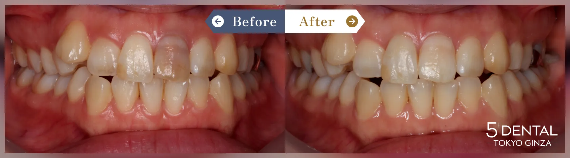 ホワイトニング Before/After症例9