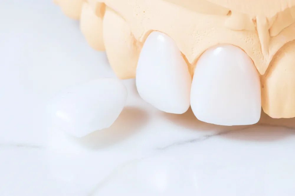 セラミック治療