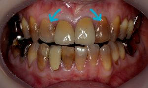 削らないラミネートベニアがおすすめの方について歯科医が解説