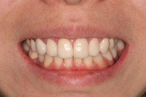 審美歯科＋咬み合せ治療＋インプラントの症例