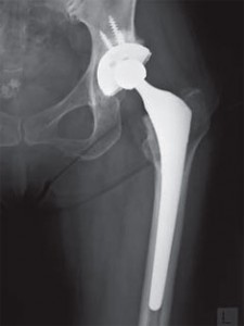 いわゆるインプラントとは？