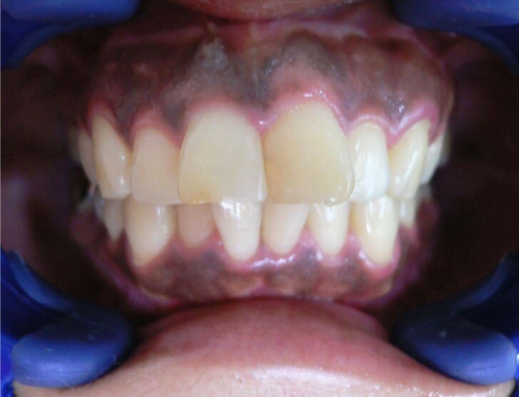 歯ぐきの黒ずみを健康的なピンク色に☆