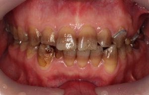 削らないラミネートベニア(テトラ歯について)