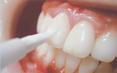 ラミネートベニアの素材を徹底解説！種類・特徴・メリット・デメリット