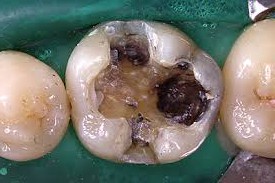 前歯6本の削らないラミネートべニアの症例を紹介！基礎知識について解説