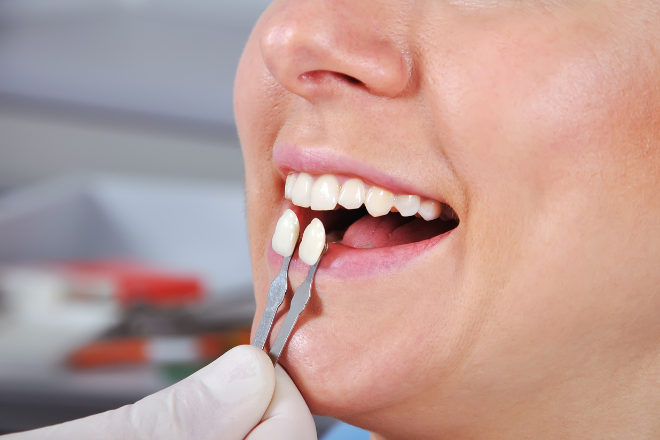 ラミネートベニアの切削量とは？削るリスクと削らない方法を解説