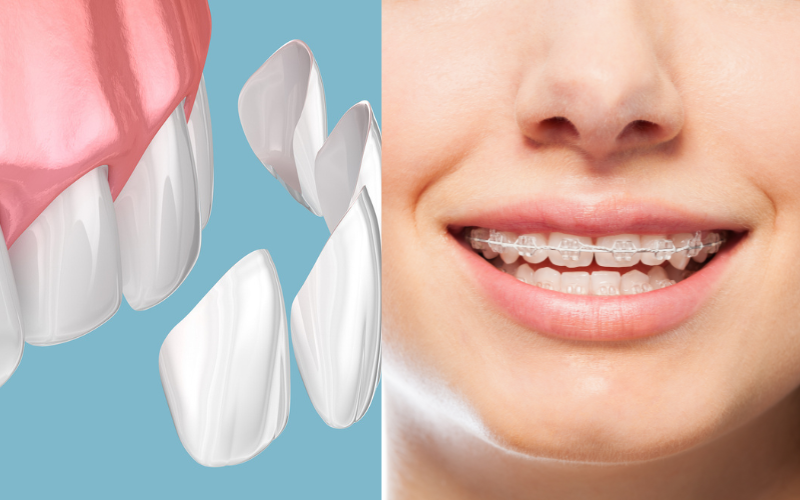 東京でラミネートベニア治療がおすすめの理由とは｜当院の症例もご紹介！