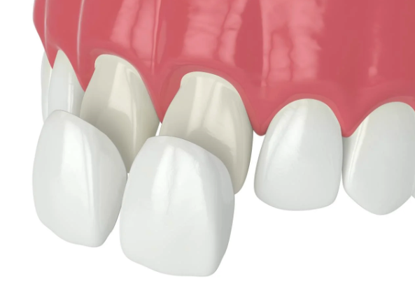 削らないラミネートベニアとは？特徴と審美歯科治療の最新情報